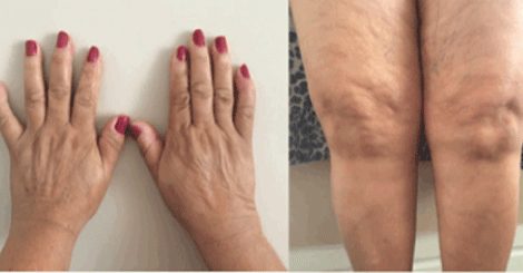 عکس روماتیسم مفصلی
