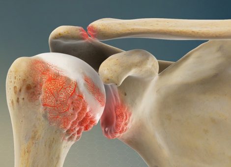علائم آرتروز شانه