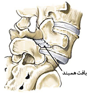 سرخوردگی مهره کمر2