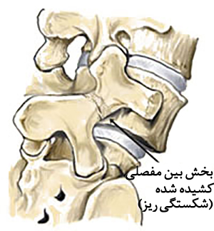 سرخوردگی مهره کمر3