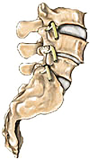 سرخوردگی مهره کمر5