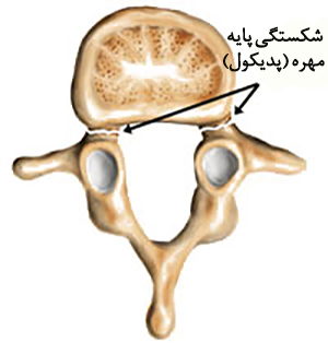 سرخوردگی مهره کمر6