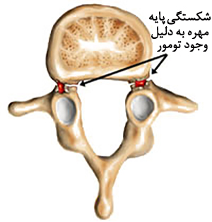 سرخوردگی مهره کمر7
