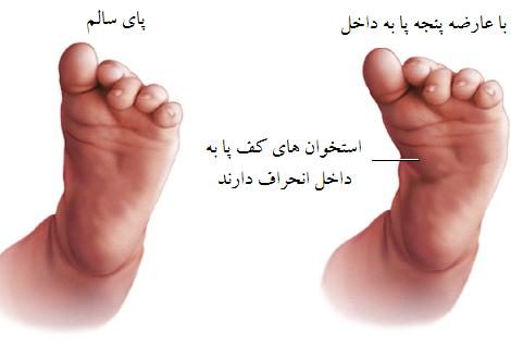 درمان چرخش پنجه پا